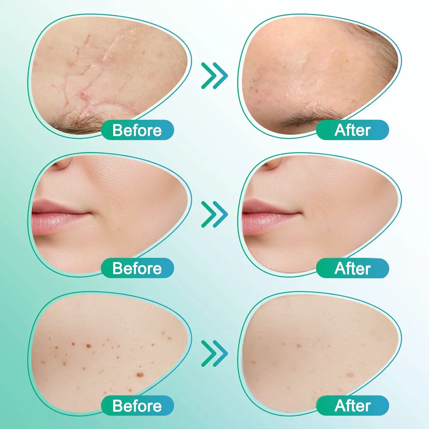 ๐๐ฎ๐ฟ๐ฒ๐๐ฟ๐ฒ๐ฒ๐๐ฒยฎ 3-in-1 Microneedle Care Patch - Image 5