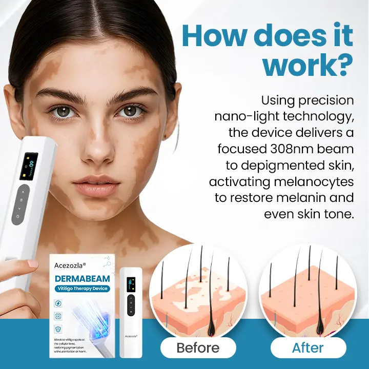 Acezozla® DermaBeam ויטיליגו מכשיר לטיפול - Image 3
